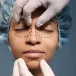 Non-surgical Rhinoplasty: How Long Does it Last?