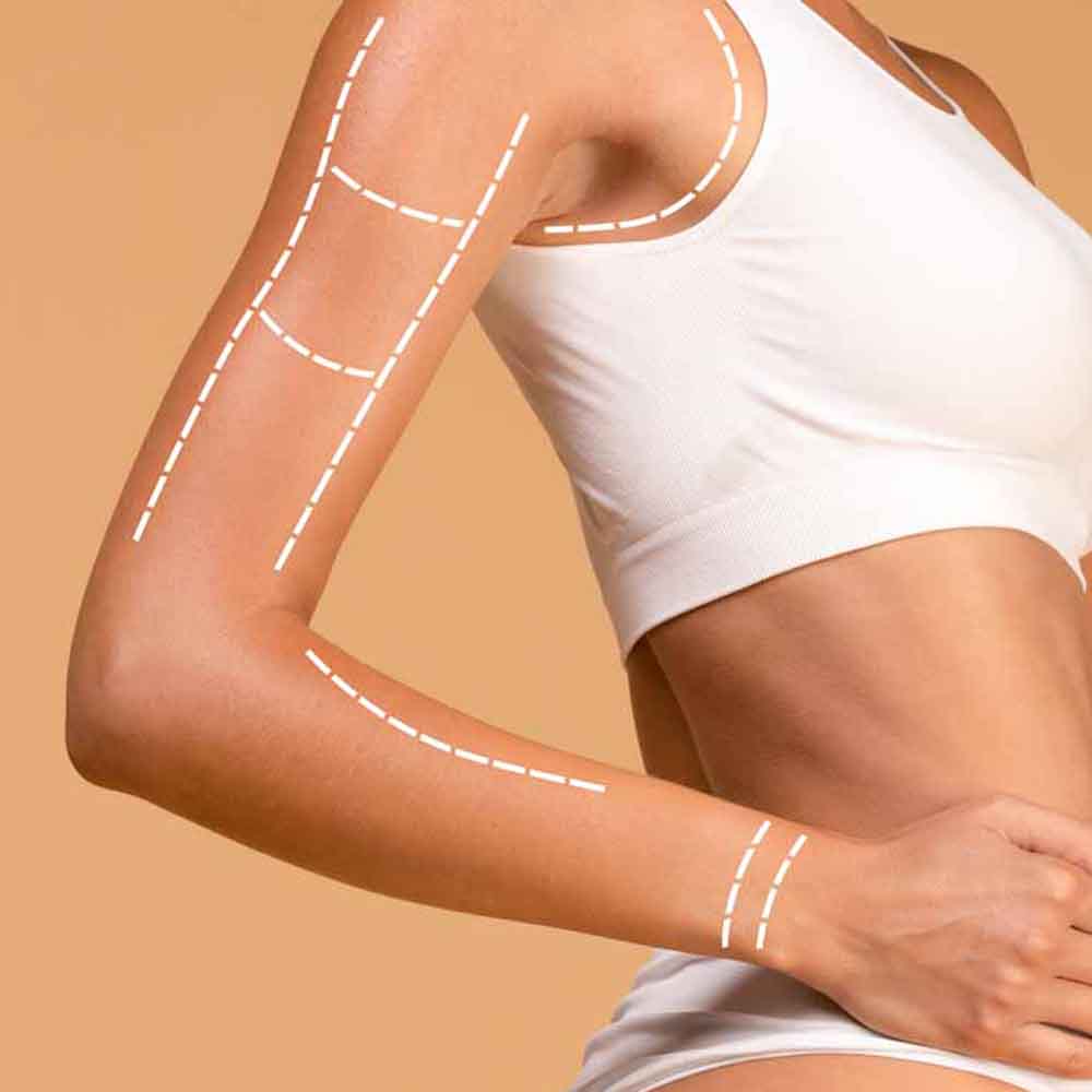 Arm Lift Surgery - Dr. Sushil Nahar - Plastic Surgeon - Rajasthan India