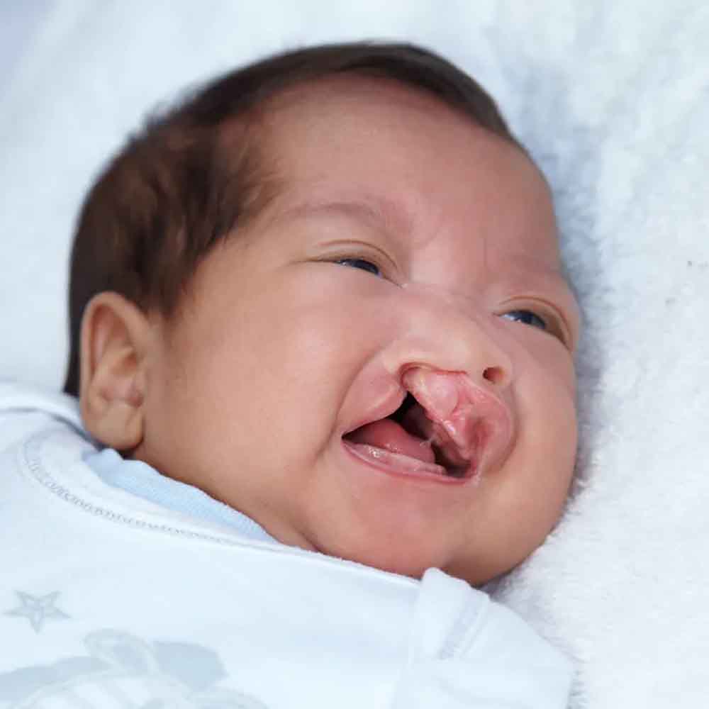 Cleft Lip and Cleft Palate Surgery - Dr. Sushil Nahar - Plastic Surgeon - Rajasthan India