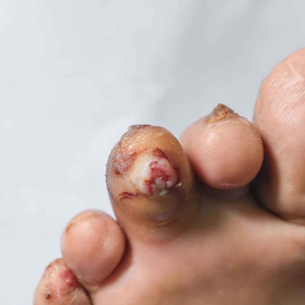 Diabetic Foot Management Surgery - Dr. Sushil Nahar - Plastic Surgeon - Rajasthan India