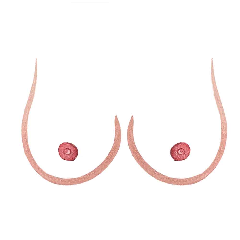 Nipple Areola Reconstruction Surgery - Dr. Sushil Nahar - Plastic Surgeon - Rajasthan India